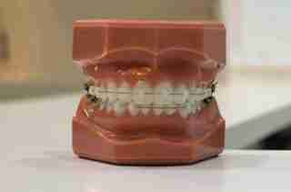 ceramic braces orthodontic treatment in Pune
